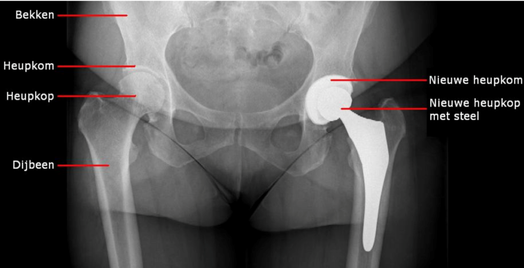 Heupslijtage Artrose En Prothesen