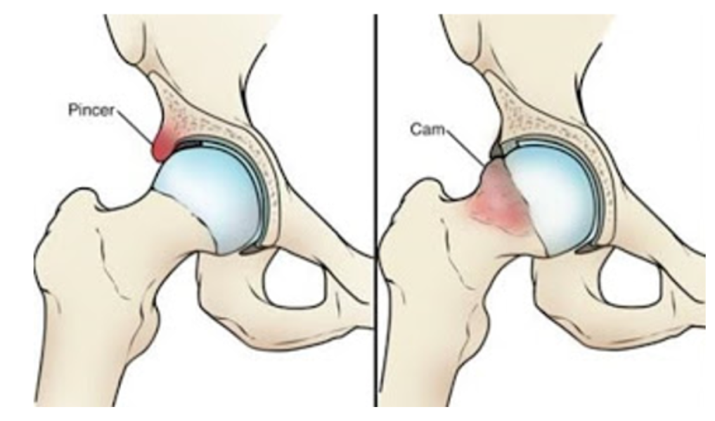 Slijtage Knie